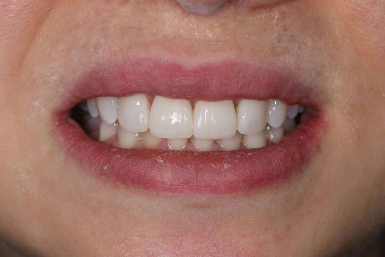 Эстетические композитные реставрации фронтальных зубов верхней челюсти