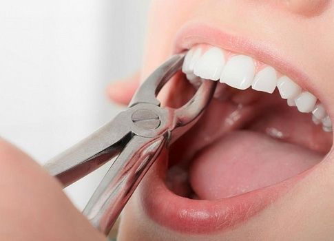 Удаление зуба: как подготовиться и что делать после