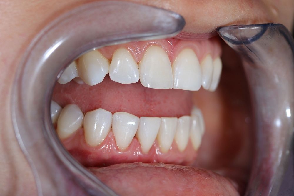 Закрытие трем между зубами, реставрация режущего края эстетическим композитом