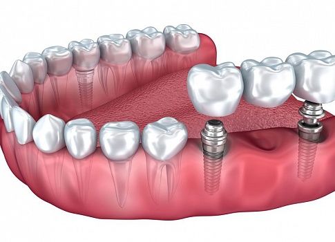 Что лучше —мостовидный протез или имплантация зубов
