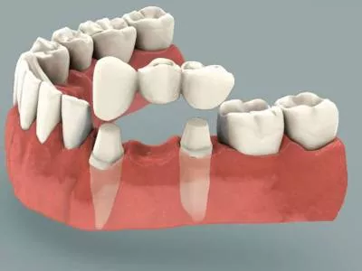несъемный зубной протез