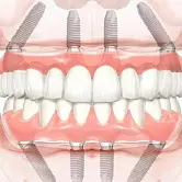 Имплантация верхних зубов