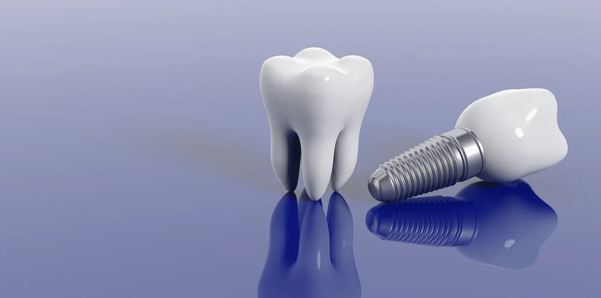 Какой зубной имплант выбрать: дешевый, недорогой, дорогой?