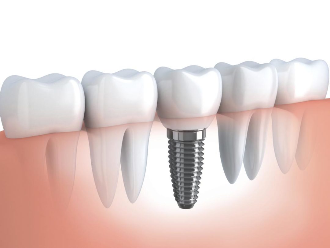 Имплантации зубов "под ключ": как рассчитать цену, какие этапы?