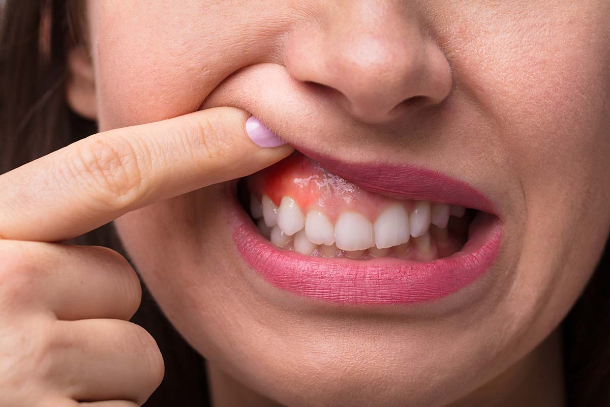 После лечения зуба болит десна – что делать, как лечить | Cтатьи от стоматологии АО Медицина