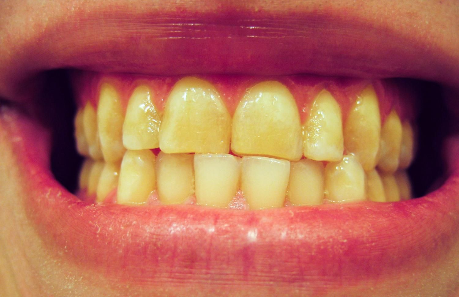Почему желтеют зубы?