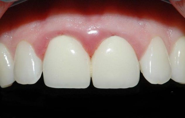 Лечение воспаленных десен - полезные статьи стоматологической сферы в блоге «Гелиоса».