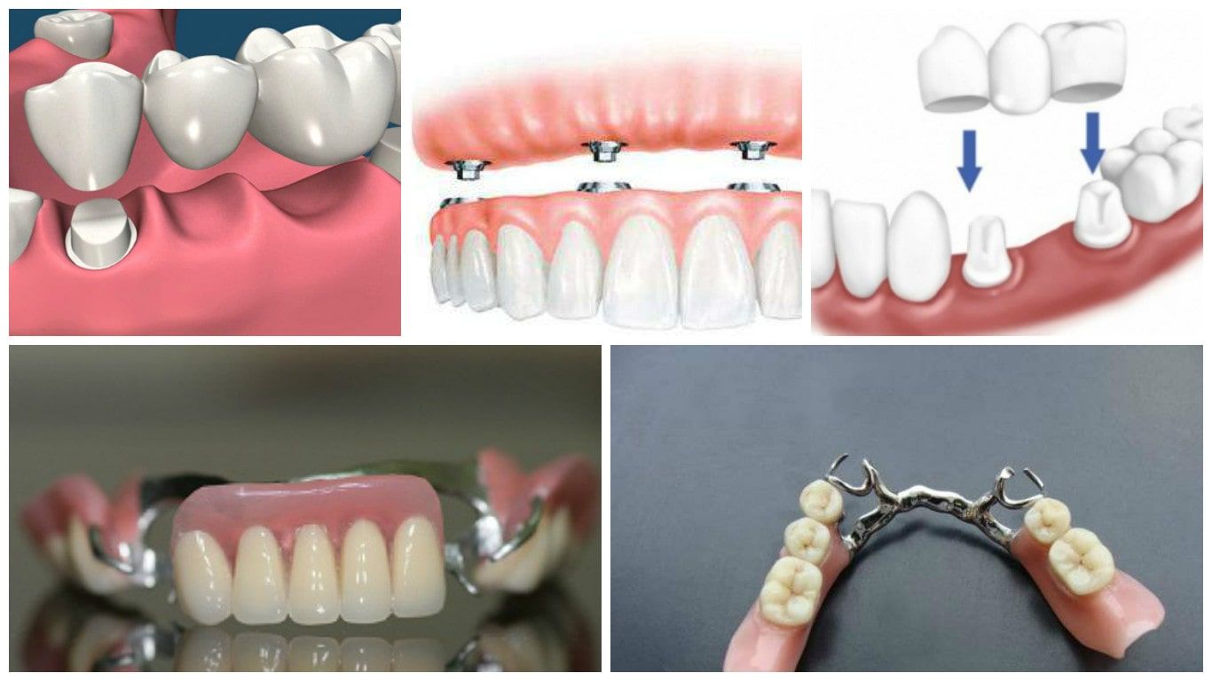 Отзывы пациентов о лучших зубных протезах