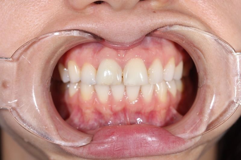 Реставрация верхнего ряда передних зубов