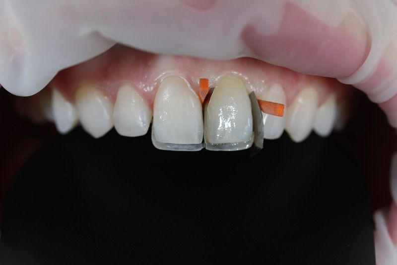Сложная реставрация зубов