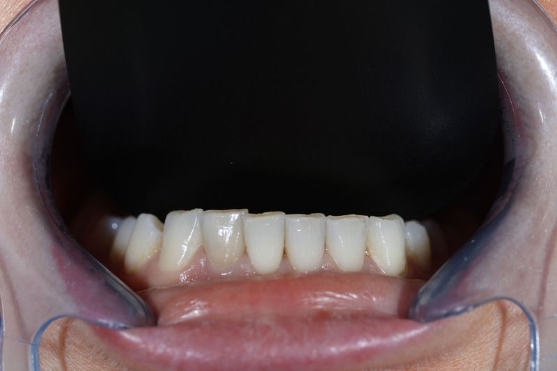 Сложная реставрация зубов