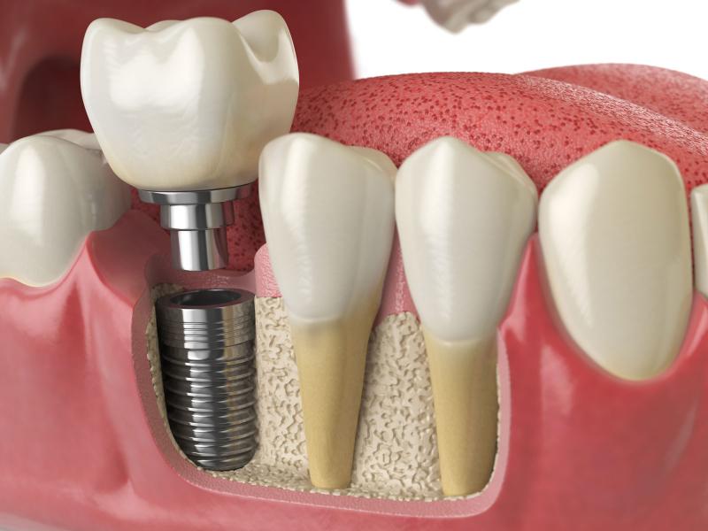 5 мифов об имплантации зубов