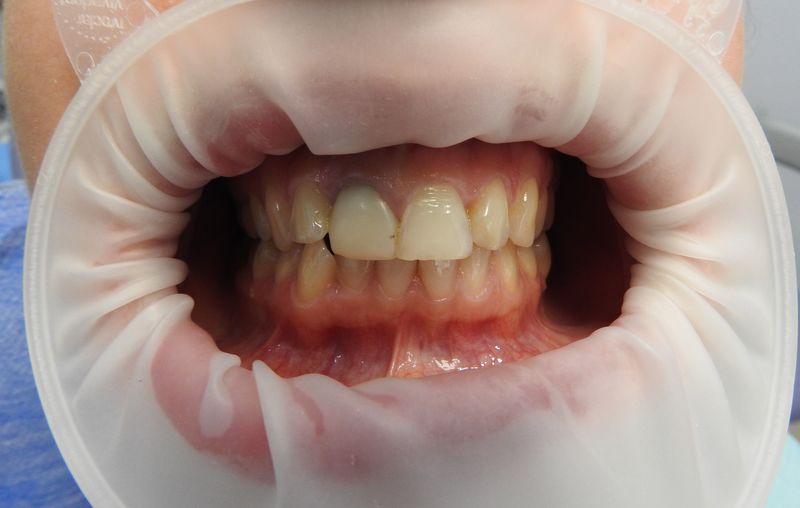 Устранение дефекта зубов