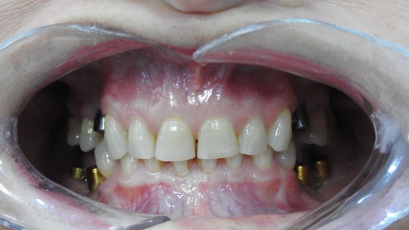 Была произведена тотальная реабилитация зубного ряда