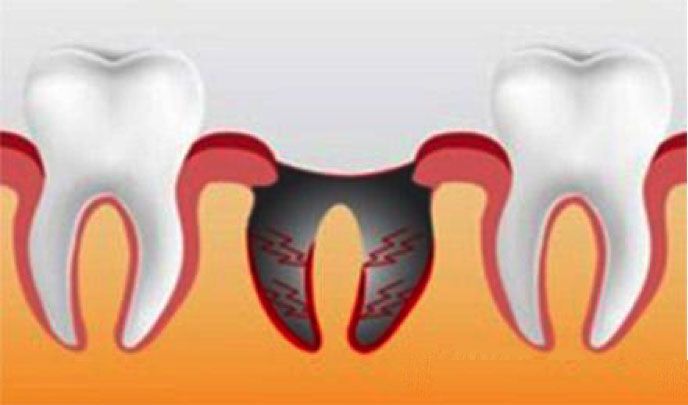 Болит десна после удаления зуба: норма или патология? Почему это происходит и что предпринять.