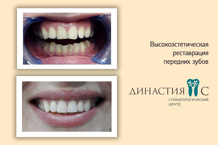 Эстетическая реставрация зубов (3 работы)