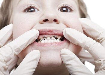 Как защитить зубы детей от кариеса? - Рассказываем!