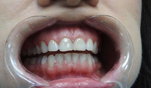 Домашнее отбеливание зубов Opalesence