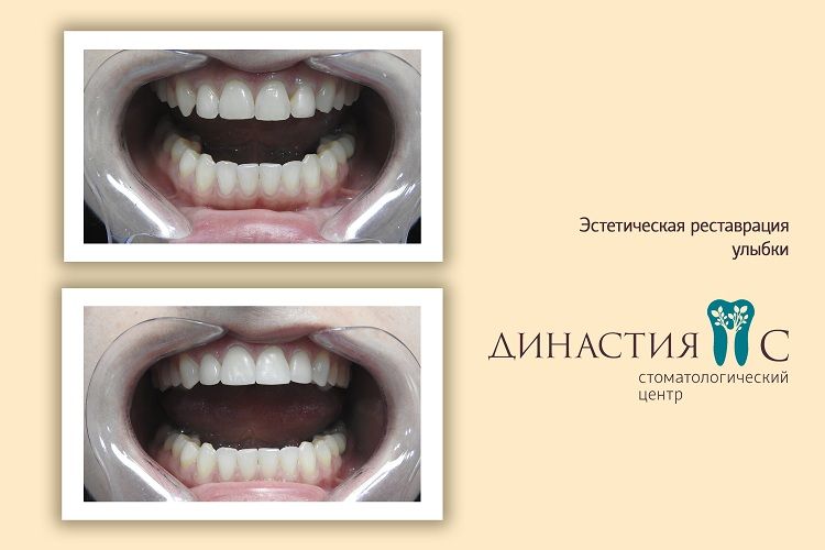 Эстетическая реставрация зубов (3 работы)