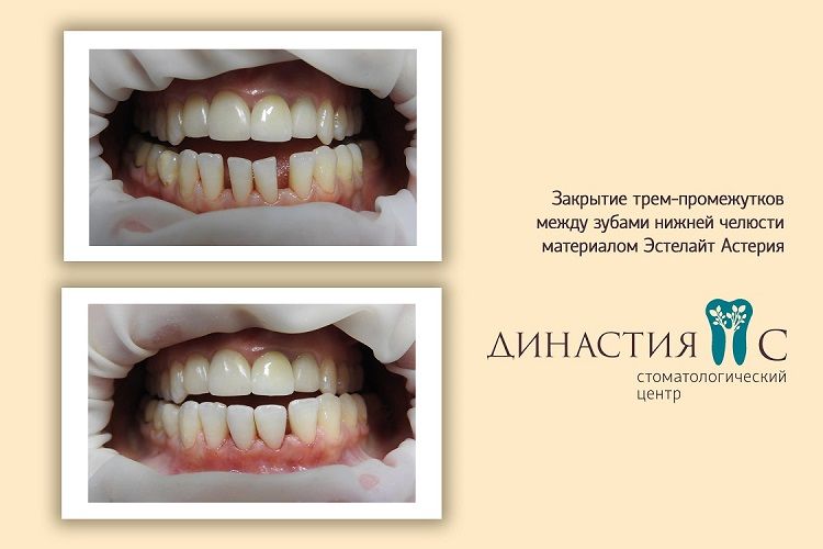 Закрытие промежутков между зубами