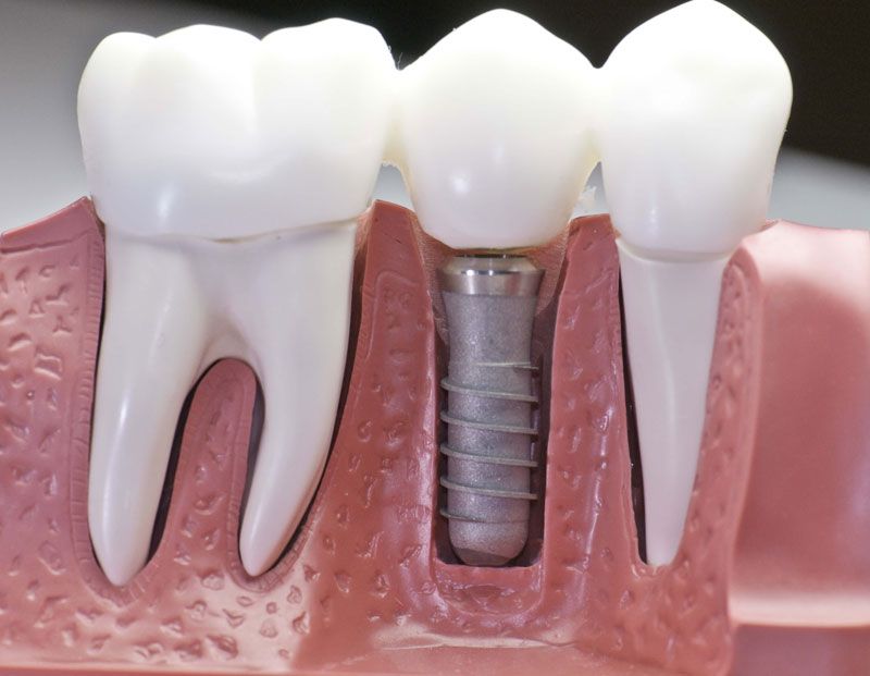 Имплантация зубов: мифы и реальность