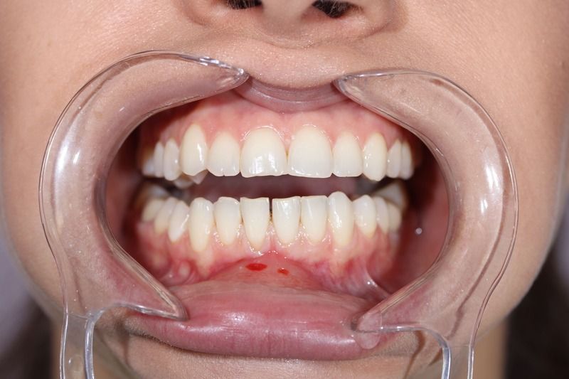 Реставрация режущего края зубов