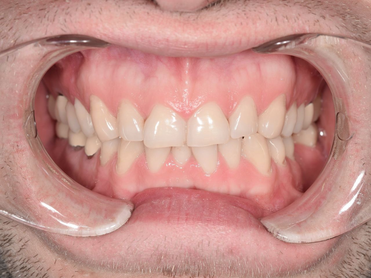 Эстетические композитные реставрации зубов верхней и нижней челюсти после ортодонтического лечения