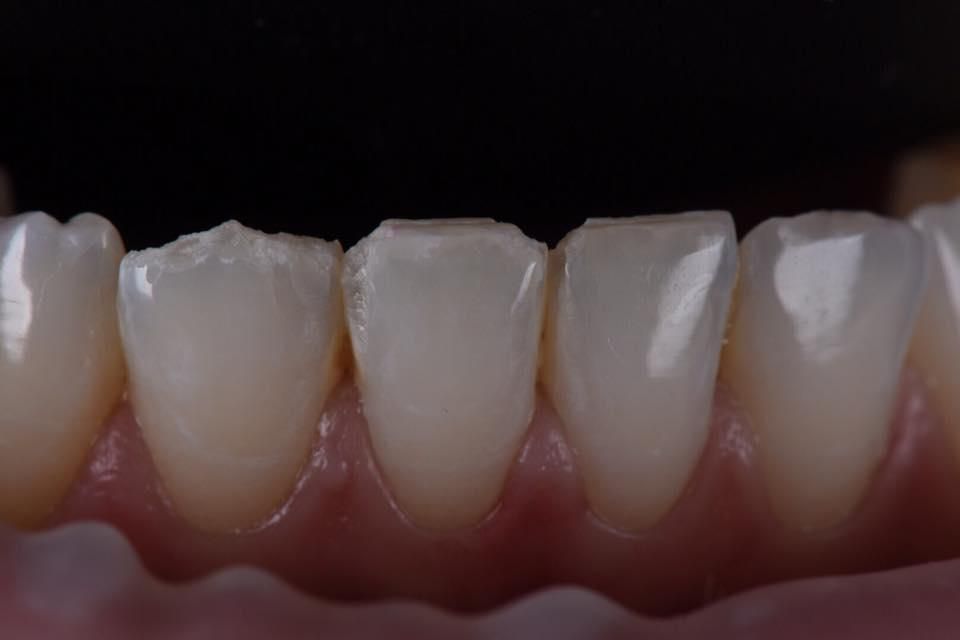 Что делать, если появился скол и трещина на зубе?