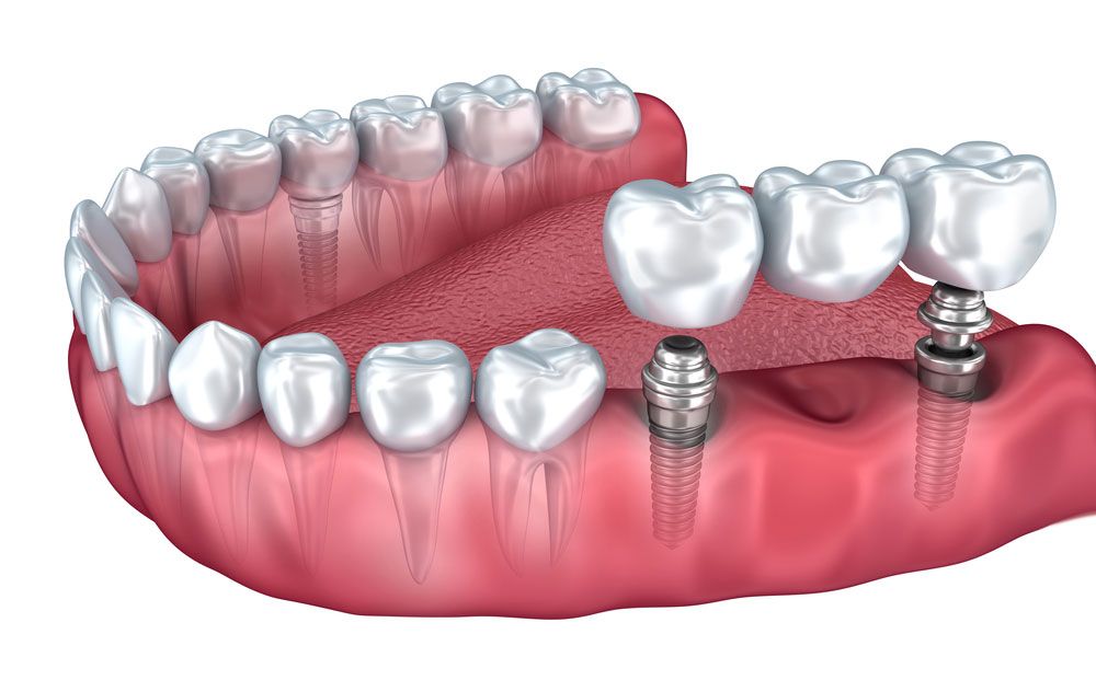 Что лучше —мостовидный протез или имплантация зубов