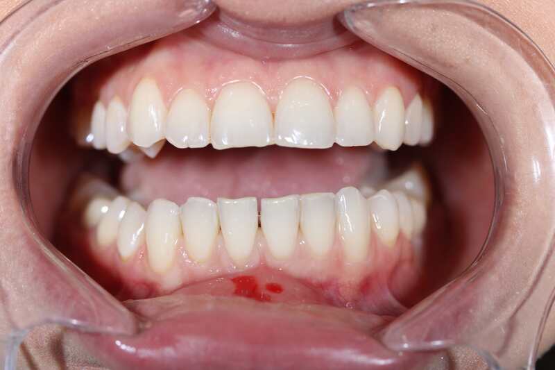 Реставрация режущего края зубов