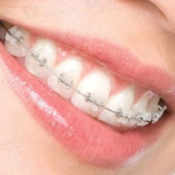 Ортодонтическое лечение зубов