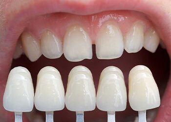 Композитная реставрация зубов или установка виниров?