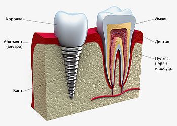 Имплантации зубов "под ключ": как рассчитать цену, какие этапы?