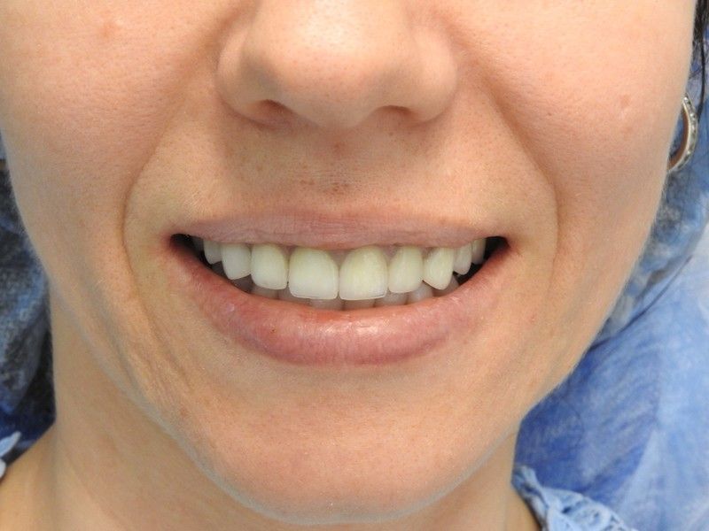 Коррекция десны, изменение дизайна улыбки, устранение дефектов зубов