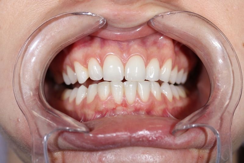 Реставрация зубов. Идеально ровный режущий край