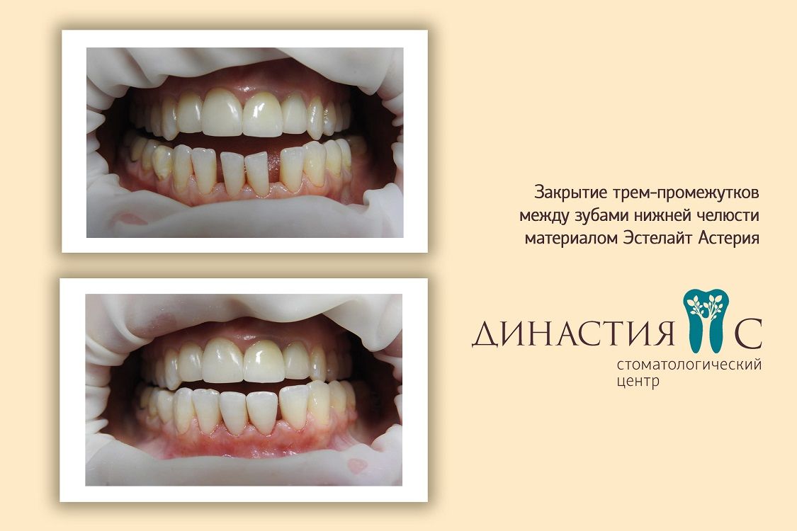 Закрытие промежутков между зубами
