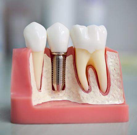 Зубные импланты, установка зубных имплантов, противопоказания, отзывы клиентов, цены.