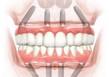 Протезирование зубов на имплантах - метод All on 4