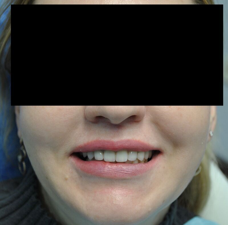 Тотальная реабилитация зубного ряда