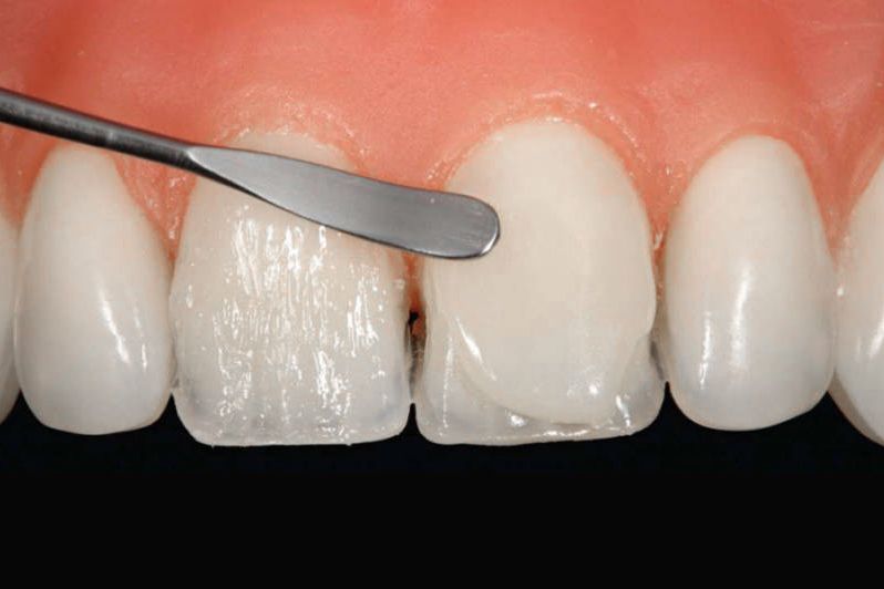 Можно ли нарастить часть зуба?
