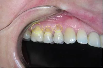 Клиновидный дефект зубов