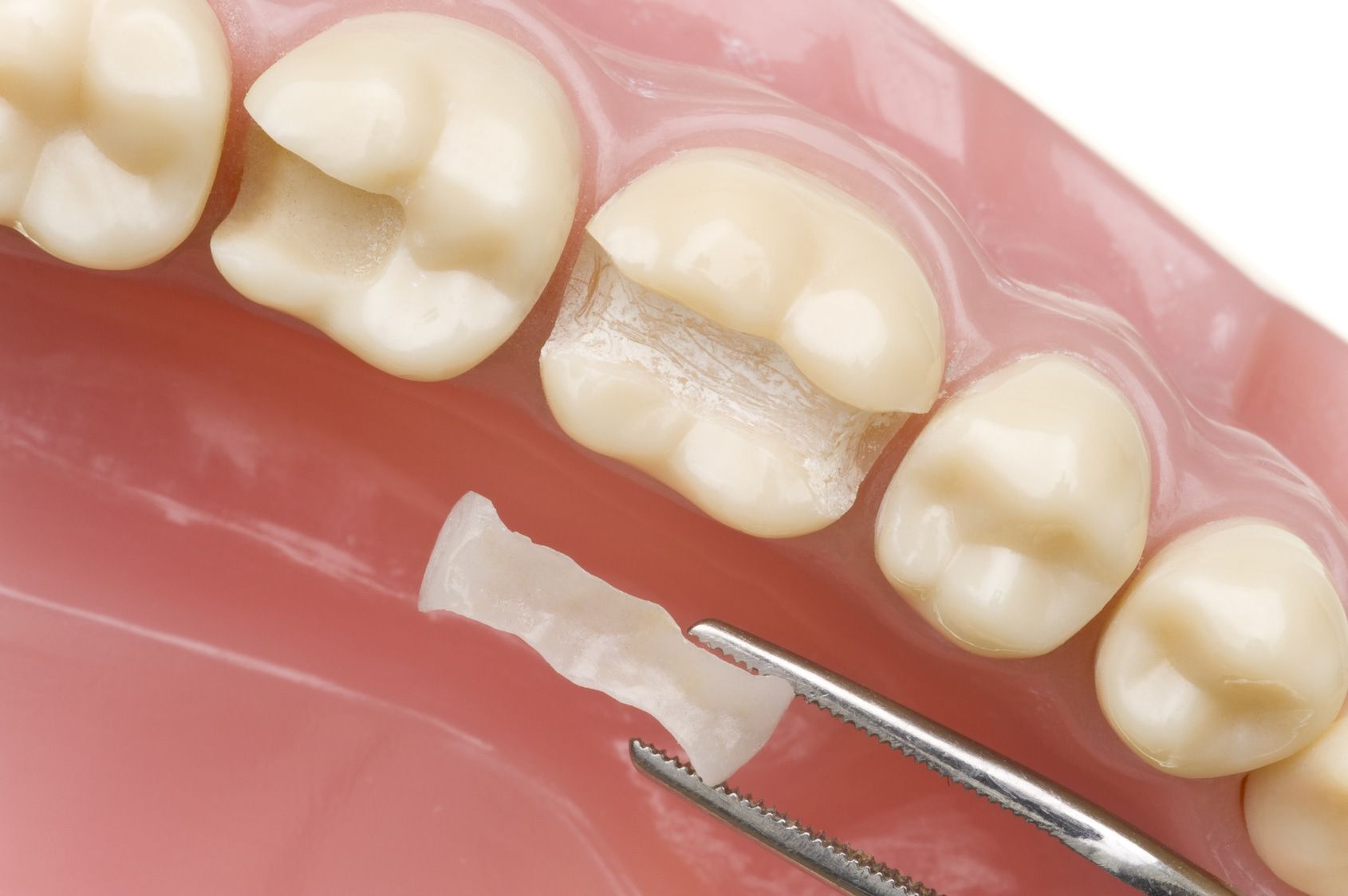 Чем вкладки отличаются от пломбирования зубов?