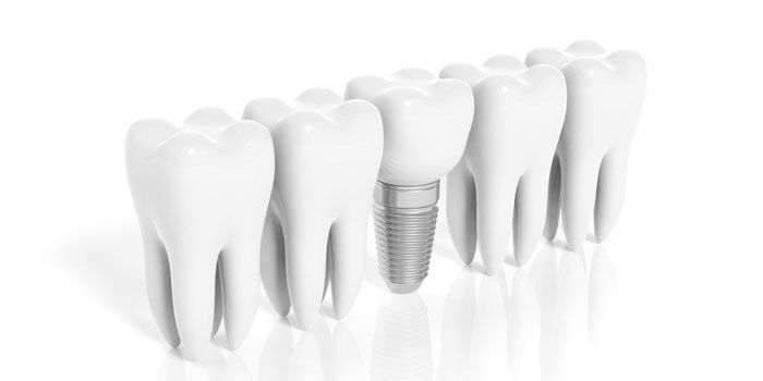 Имплантация зубов – сроки службы