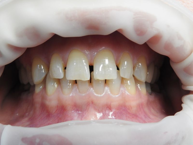 Устранение трем, диастем, зубных промежутков