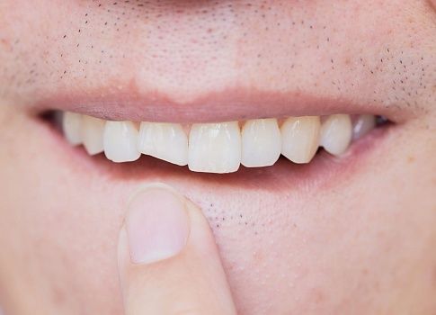 Что делать, если появился скол и трещина на зубе?