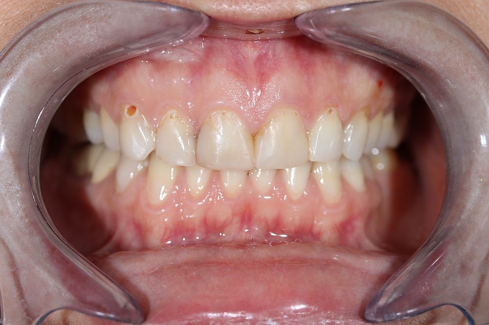 Эстетические композитные реставрации фронтальных зубов верхней челюсти