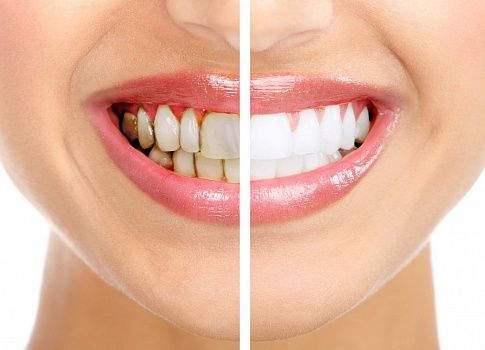 Удаление зубного налета и камня в стоматологии