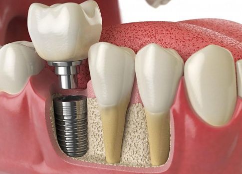 5 мифов об имплантации зубов