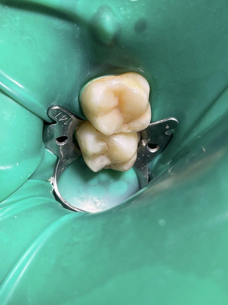 Полное анатомическое восстановление цвета и формы зуба, с тонировкой фиссур