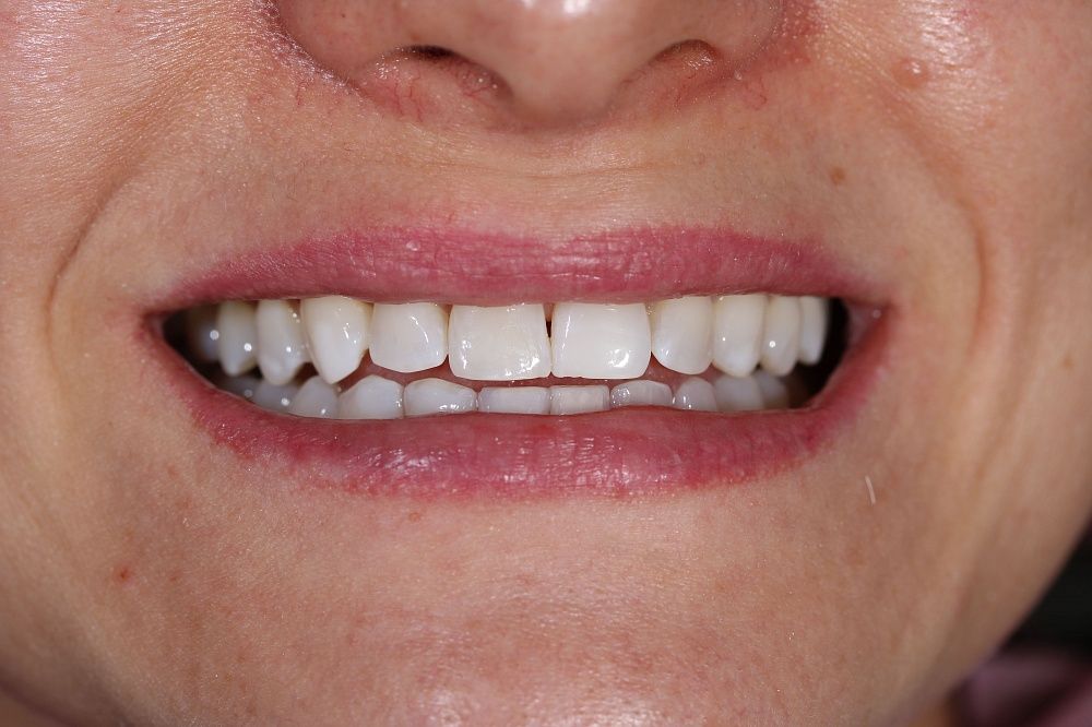 Закрытие трем между зубами, реставрация режущего края эстетическим композитом
